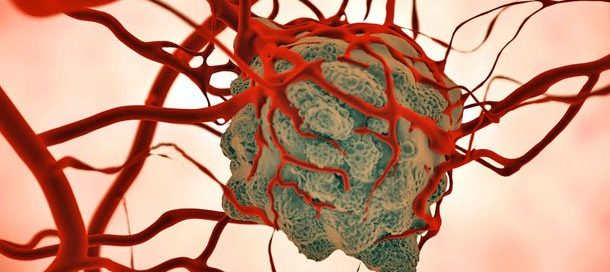 Early Symptoms, Treatment, Life Expectancy & Staging