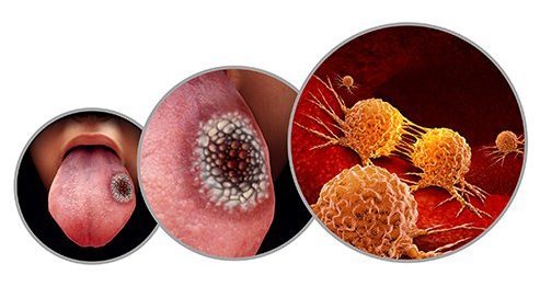 What Does Cancer Look Like on Your Tongue?