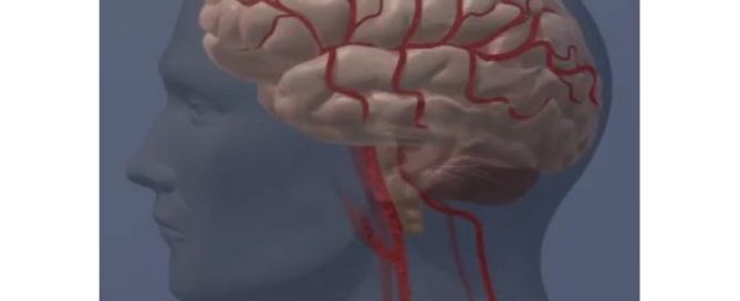 Stroke risk highest among American Indian people, with or without AFib