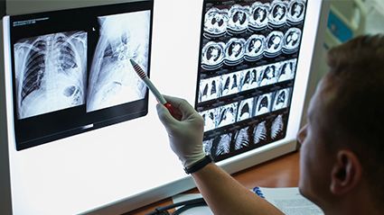 COVID Fears Mean More Cancers Are Being Diagnosed at Later Stages