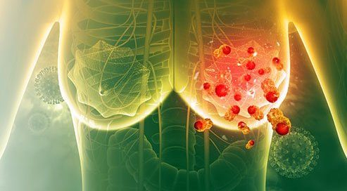 Is Breast Cancer Metastatic Terminal?