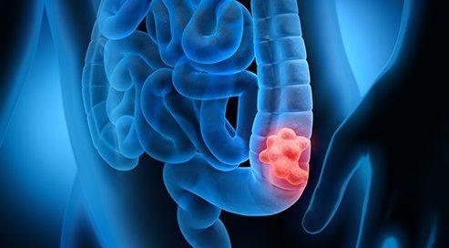 How Do You Know if You Have Cancer in Your Intestines? Bowel Cancer Signs