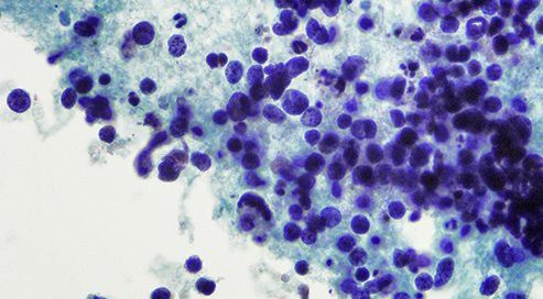 What Is Lung Adenocarcinoma?