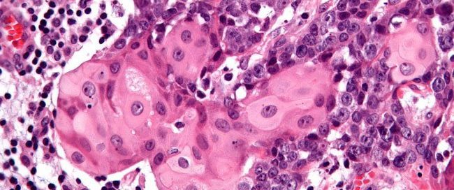 Is NUT Carcinoma Curable?