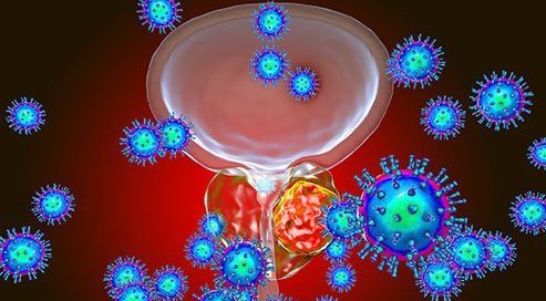 What Is Stage IV Prostate Cancer Life Expectancy? Treatment Options