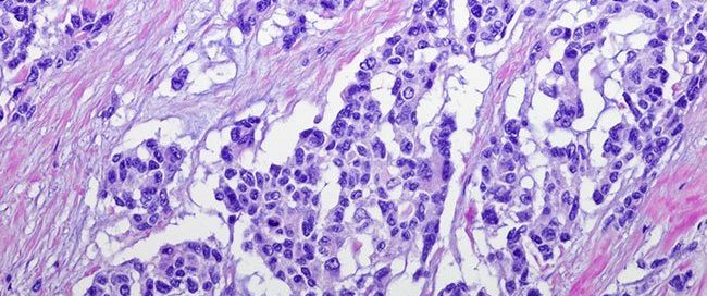 What Is RMS Disease? 4 Types, Symptoms, Treatment & Tests