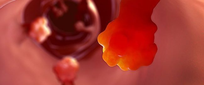 What Causes a GIST Tumor? Symptoms and Causes