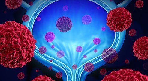 How Long Will You Live if You Have Bladder Cancer?