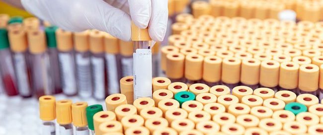 Can Pancreatic Cancer Be Detected by Blood Test? 7 Effective Tests