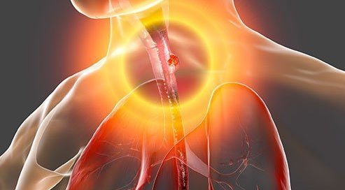 How Long Do You Live After Being Diagnosed With Esophageal Cancer?