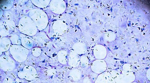 Lipoma vs. Liposarcoma: What Is the Difference?