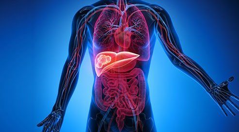 What Is the Main Cause of Kidney Cancer? Types and 10 Risk Factors