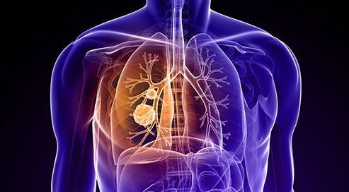 Can You Survive Metastatic Lung Cancer? Metastasis Symptoms