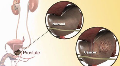 Can You Keep Your Bladder After Bladder Cancer Strikes?