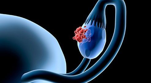 Types of Ovarian Cancer Medications