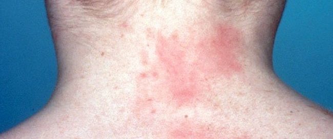 What Does a Lymphoma Skin Rash Look Like? Stages & Treatment