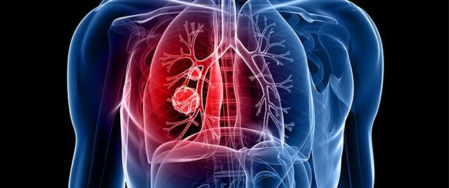 Where Do Pancreatic Neuroendocrine Tumors Metastasize? Lifespan Chart
