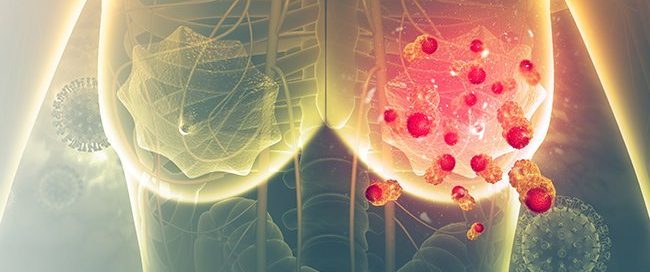 How Is PIK3CA Mutation Treated? Piqray for Breast Cancer