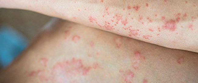 Where Does Leukemia Rash Appear? 5 Types