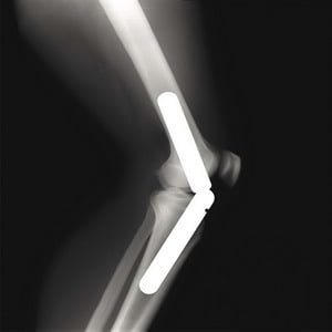 LP-Hinged Knee Stabilizer