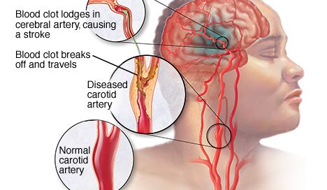 Stroke – Symptoms and Causes