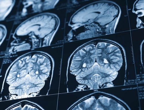 Brain imaging, telehealth studies promise better stroke prevention and recovery
